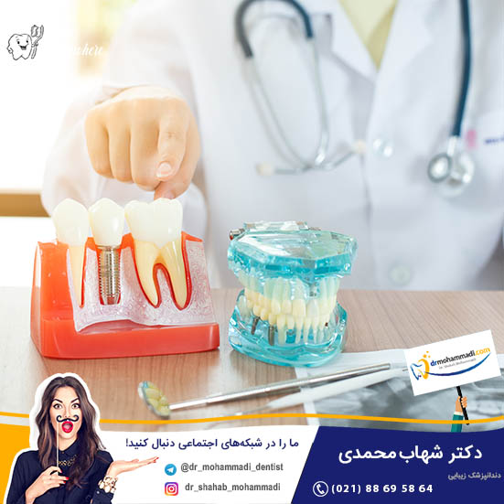 آیا بدن ایمپلنت دندان را پس‌می‌زند؟ - کلینیک دندانپزشکی دکتر شهاب محمدی